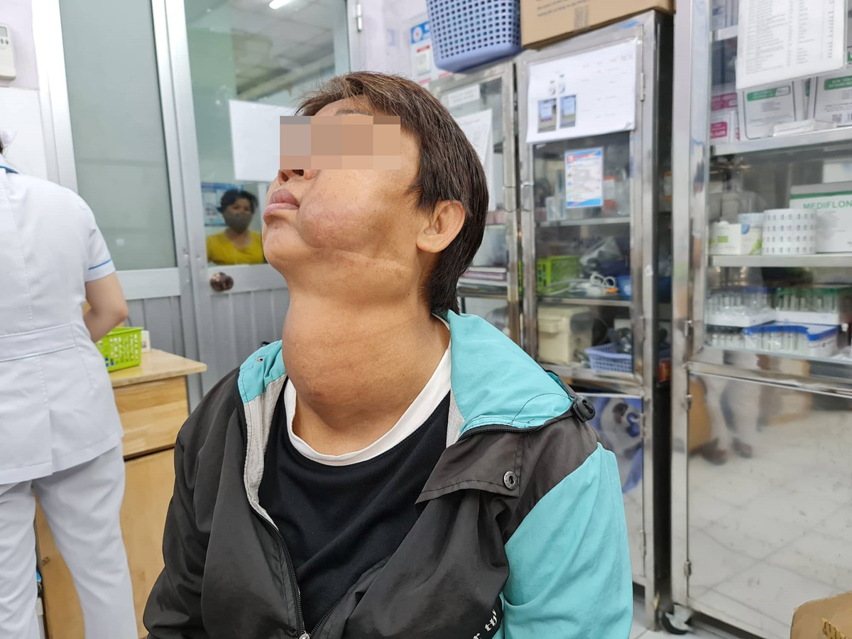 U lon tuyen giap ket hop u mau day khi quan va thuc quan sang phai