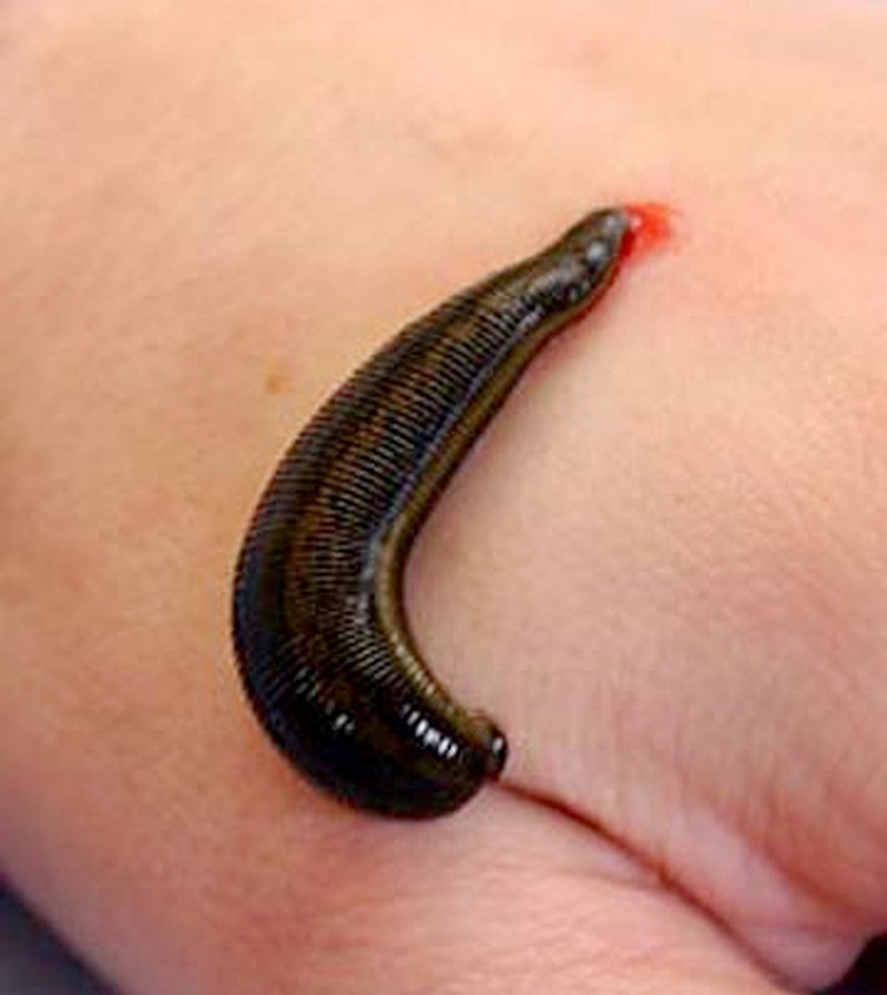 Quang Nam: Can bo thu y gap con dia dai hon 10cm tu mui nguoi