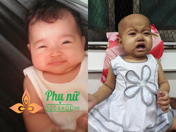 Be 15 thang bi ung thu mau, cha ban ve so tich cop tung dong chua benh cho con