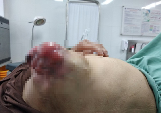 Nguc sung phong, chay mu lo loet vi dap la chua ung thu