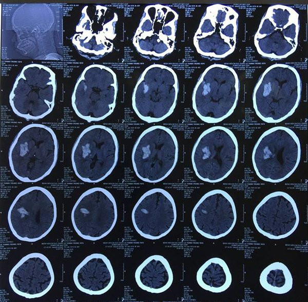 Hình ảnh khối máu tụ trong não bệnh nhân