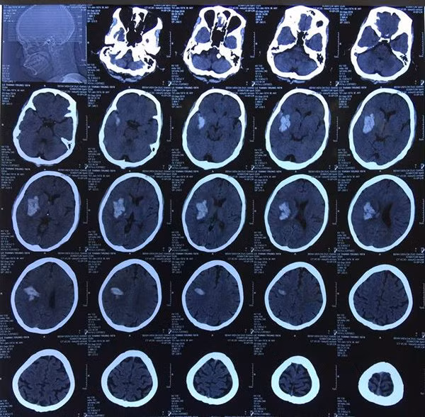 Hình ảnh khối máu tụ trong não bệnh nhân