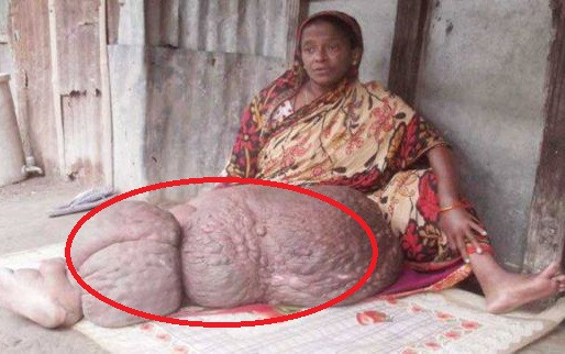 Chan khong lo gan 60 kg khien nguoi phu nu liet suot 18 nam