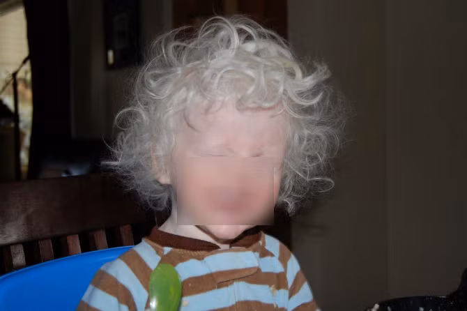 Số ca mắc bệnh bạch tạng cao nhất trên thế giới được ghi nhận ở Tanzania, Châu Phi.