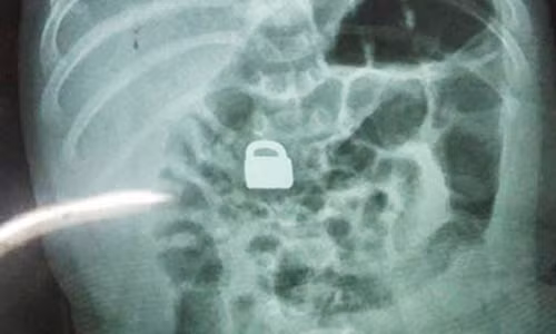 Hai hung phat hien o khoa trong bung be 2 thang tuoi