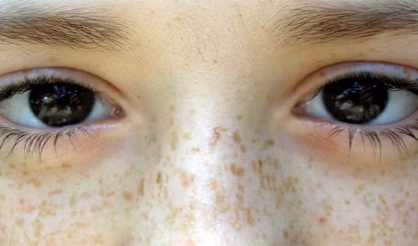 Vào thời xưa, những người bị tàn nhan thường bị chê là xấu xí. Để xóa tàn nhang, người ta thường sử dụng lưu huỳnh chà sát vào vùng da bị tàn nhan để loại bỏ chúng.