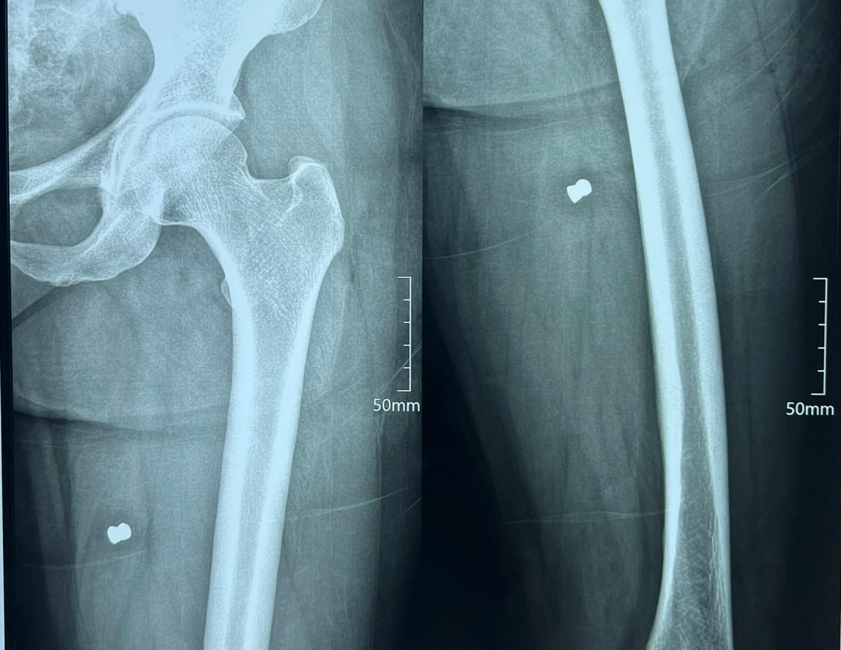 Người dân sống gần khu vực nghe tiếng súng nổ chạy đến và đưa hai chị đi cấp cứu tại Bệnh viện Đa khoa Phúc Hưng. Kết quả chụp phim cho thấy cả hai người đều có đầu đạn trong đùi và bắp chân.