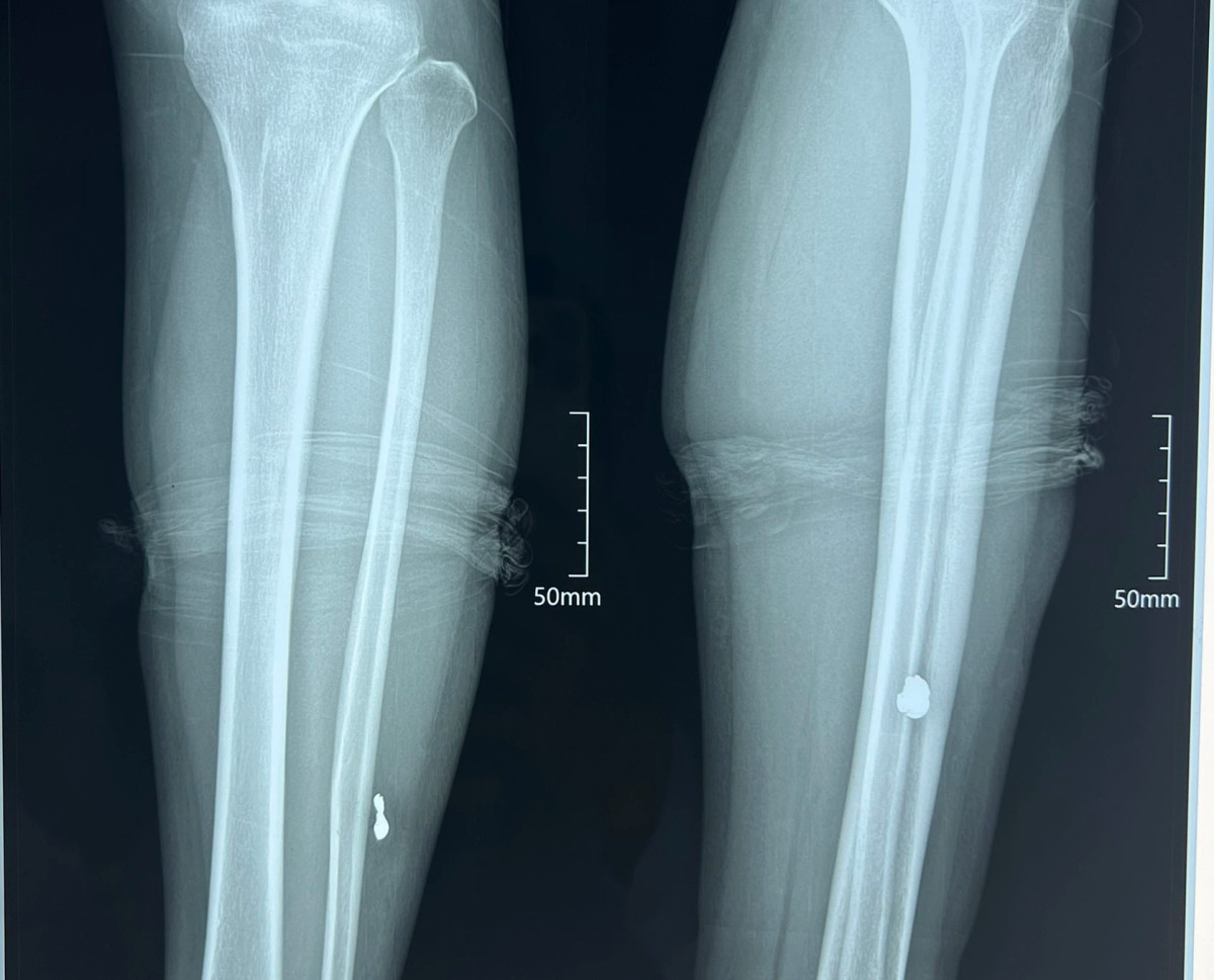 Đến 13h chiều cùng ngày, hai nạn nhân đã được phẫu thuật lấy đầu đạn ra khỏi cơ thể, sức khỏe tạm thời ổn định.