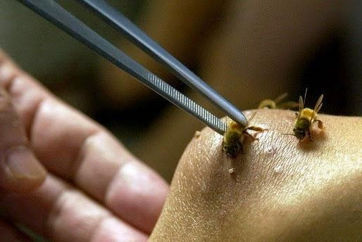 Nọc ong được chứa trong 2 tuyến nọc dẫn vào một kim chích sau đít ong. Vì vậy, sau khi bị ong chích, cần rửa sạch những chỗ có vết chích bằng xà phòng hoặc dung dịch sát trùng và dùng kềm nhỏ để rút hết các vòi chích của ong ra, có thể đắp khăn lạnh hay túi chườm nước đá lên vùng sưng nề trong khoảng 15-20 phút để làm giảm đau giảm đau và giảm sưng.