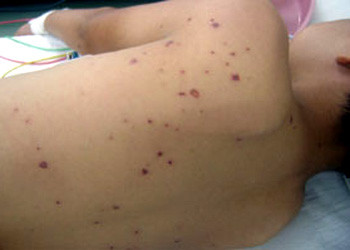 Loại o­ng to thường làm tổ trên mặt đất hoặc hố đất, nọc o­ng có độc tính rất cao. Chúng thường làm tổ ở các gò, đồi, mô đất cao hơi yên tĩnh, thường xa nhà và nơi thả gia súc. Chỉ khoảng chừng 1-2 con o­ng đốt đã có thể làm cho nạn nhân bị sốt.