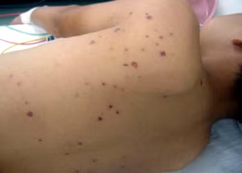 Loại o­ng to thường làm tổ trên mặt đất hoặc hố đất, nọc o­ng có độc tính rất cao. Chúng thường làm tổ ở các gò, đồi, mô đất cao hơi yên tĩnh, thường xa nhà và nơi thả gia súc. Chỉ khoảng chừng 1-2 con o­ng đốt đã có thể làm cho nạn nhân bị sốt.