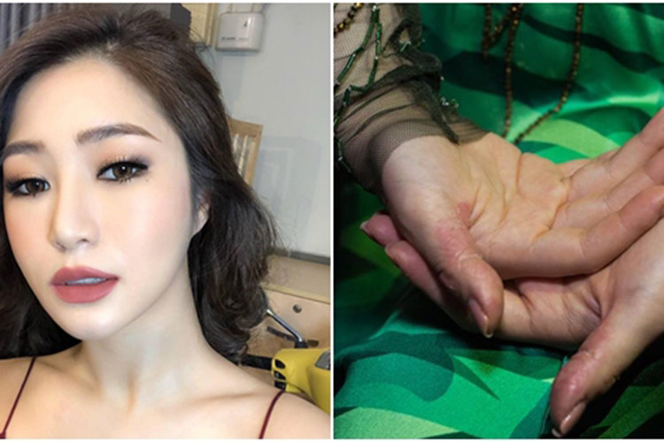 Do thường xuyên rơi vào tình trạng căng thẳng, Hương Tràm tự bóc da tay đến mức chảy máu Ảnh: Thế giới trẻ