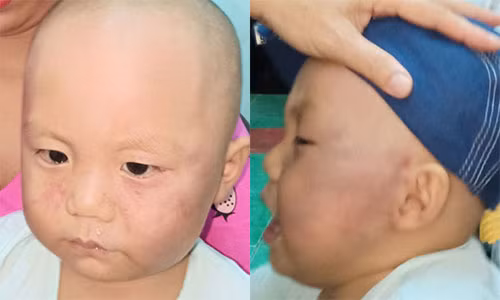 Bao mau danh be trai 19 thang tuoi phai nhap vien