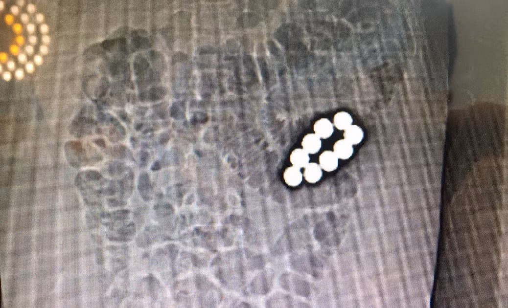 Nam sinh tieu hoc nuot 9 vien bi sat vi ban cuong ep?-Hinh-2