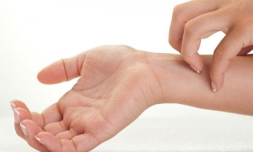 Ngoài ra, mạt còn gây các bệnh ngoài ra như sưng đỏ, ngứa, nổi bóng nước do chúng cắn đốt.