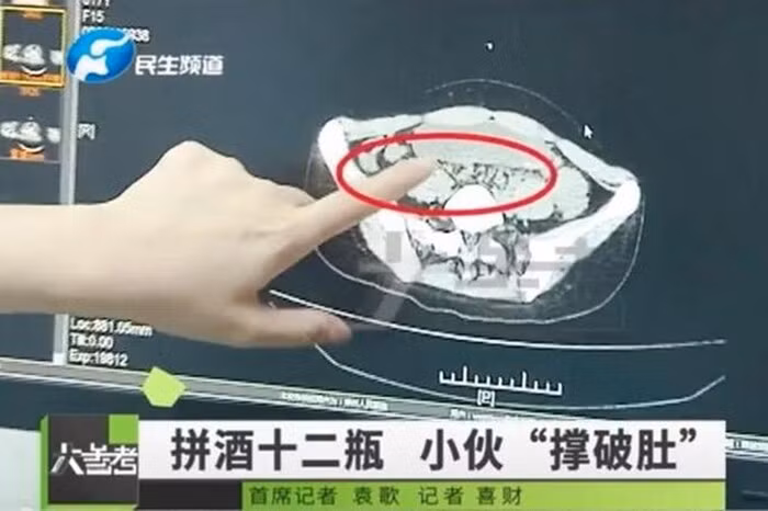 Nam sính Li suýt thủng dạ dày sau khi uống 12 chai bia liên tiếp.