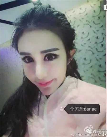 Các đường nét trên khuôn mặt cũ của Lý Ân Hy bị "tàn phá" nặng nề. Quá thích sở hữu đôi mắt to, cằm V-line, mũi thẳng tắp... mà Lý Ân Hy đã vô tình tạo nên một thảm họa phẫu thuật thẩm mỹ thực sự.