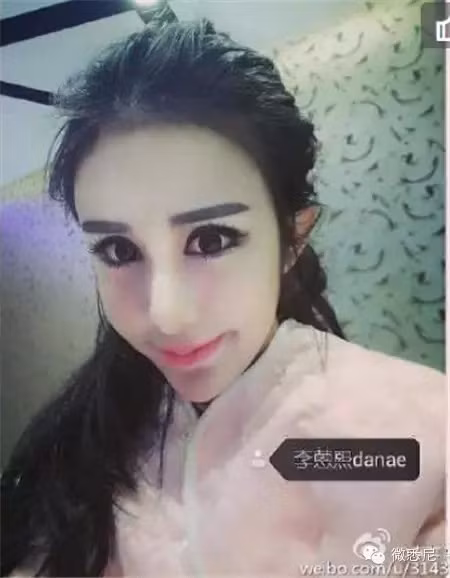 Các đường nét trên khuôn mặt cũ của Lý Ân Hy bị "tàn phá" nặng nề. Quá thích sở hữu đôi mắt to, cằm V-line, mũi thẳng tắp... mà Lý Ân Hy đã vô tình tạo nên một thảm họa phẫu thuật thẩm mỹ thực sự.