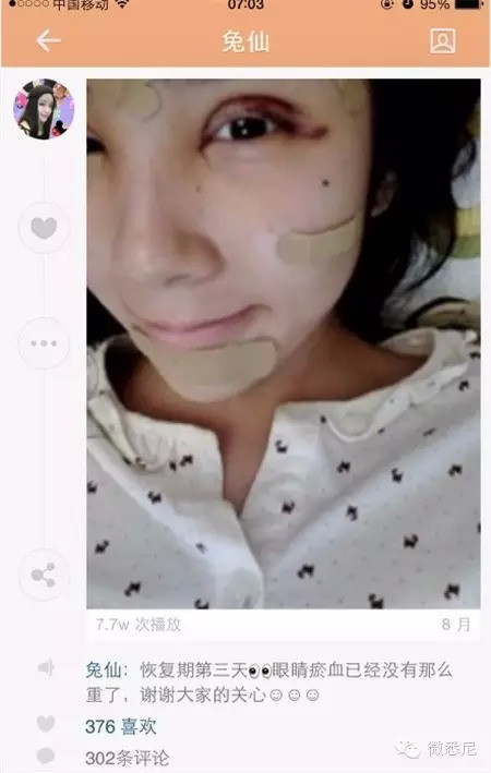 Trong suốt quá trình làm phẫu thuật thẩm mỹ, Lý Ân Hy cũng thường xuyên chia sẻ những bức ảnh chụp khuôn mặt bị băng bó của mình lên mạng. Kể từ đó đã có một chiều hướng bình luận, một luồng ý kiến phản đối rất lớn xuất hiện, cho rằng cô mẫu tuổi teen đang tự hủy hoại nhan sắc của mình chứ không phải đang làm đẹp.