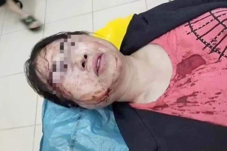 Chuẩn bị ra toà ly hôn, người phụ nữ bị chồng đánh nhập viện Chuan bi ra toa ly hon, nguoi phu nu bi chong danh nhap vien