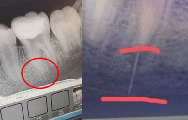 Dieu tri tuy rang, be gai bi nha si lam chuyen ron nguoi