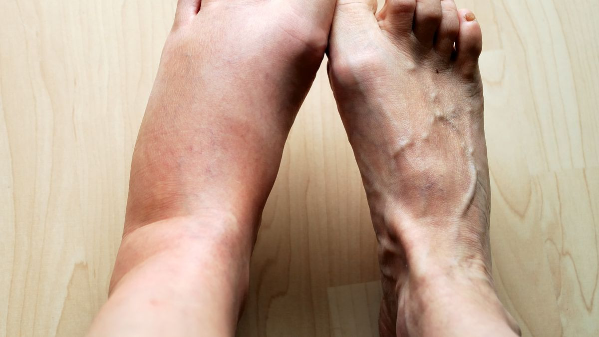 Dau hieu o ban chan canh bao som tieu duong tuyp 2 nguy hiem