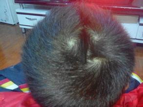 Người có ba xoáy: Đây không phải là trường hợp phổ biến vì thế mà tính cách của những người này cũng có phần khác người. Tính cách thường thất thường, không ổn định, kết giao với bạn bè cũng lúc không thân cũng chẳng sơ, có lúc thì nhiệt tình nhưng có lúc lại thờ ơ hờ hững.