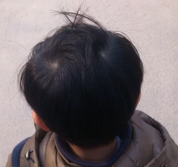 Tuy bề ngoài không thể hiện ra nhưng họ là người vô cùng kiên cường. Không thích bị bó buộc và không muốn làm những việc bị bắt ép. Nhưng đây cũng chính là điểm yếu khiển họ đôi khi phải nếm trải cảm giác cay đắng của thất bại. Trẻ có hai xoáy trên đầu thì đều vô cùng thông minh, học một biết mười, vô cùng lì lợm. Bé trai mà có hai xoáy thì là người luôn lấy chữ hiếu giữ hàng đầu, bé gái mà có hai xoáy thì ngược lại.