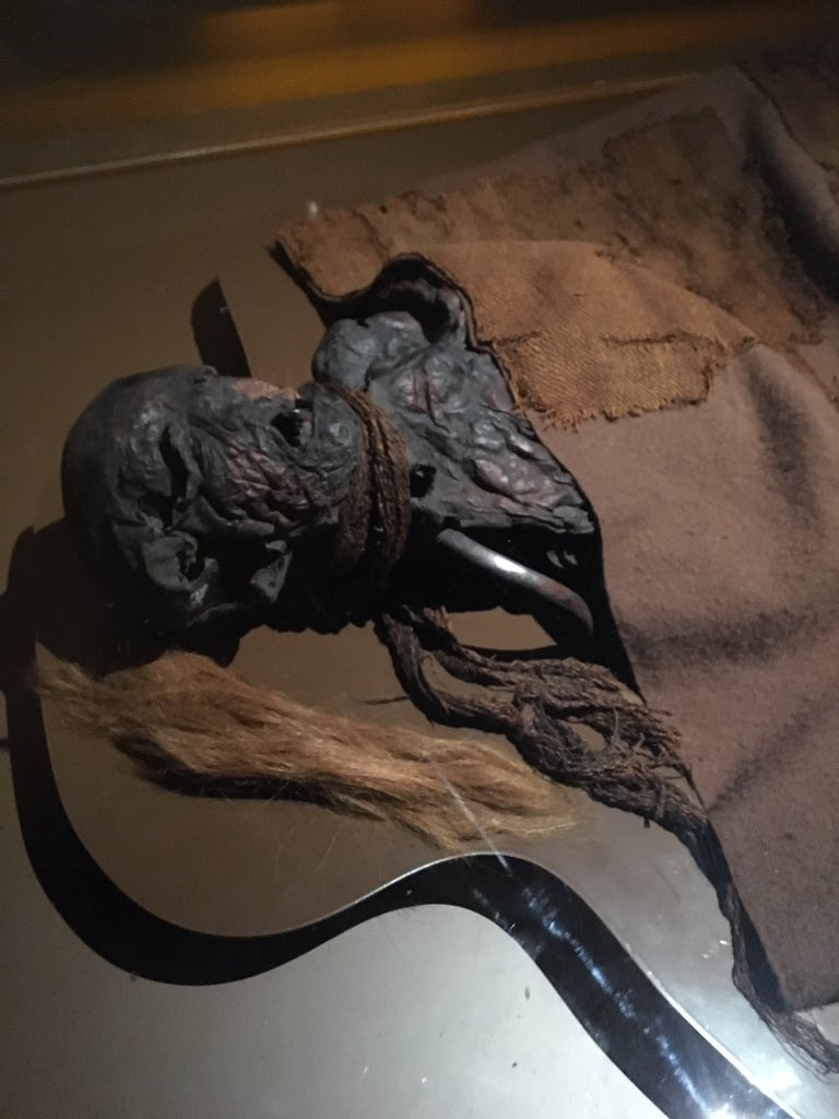 Kết quả chụp CT cho thấy cô gái Yde bị cong vẹo cột sống và chân phải sưng to bất thường. Điều này khiến cô đi lại khập khiễng.