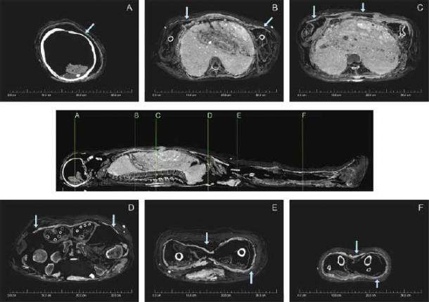 Cụ thể, sau khi qua đời, cô gái Ai Cập trên được ướp xác theo cách thông thường với thi hài được quấn bằng vải lanh và sử dụng các dược liệu.