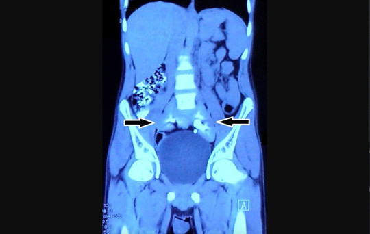 Chup phim thay 2 qua than bien mat, chi con 1… chiec dia!