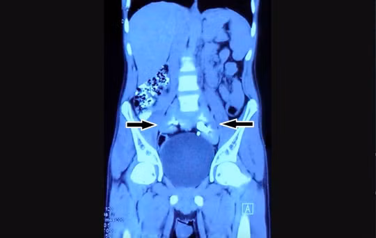 Chup phim thay 2 qua than bien mat, chi con 1… chiec dia!