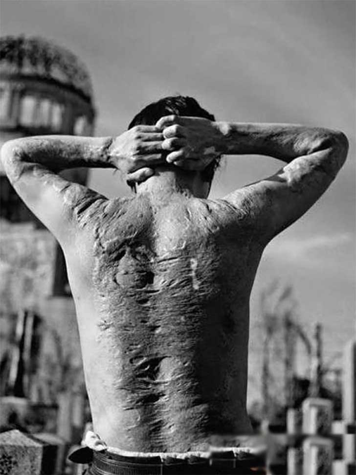 Những vết sẹo khủng khiếp trên cơ thể một người đàn ông bị ảnh hưởng từ vụ nổ bom hạt nhân ở Hiroshima, Nhật Bản năm 1945.