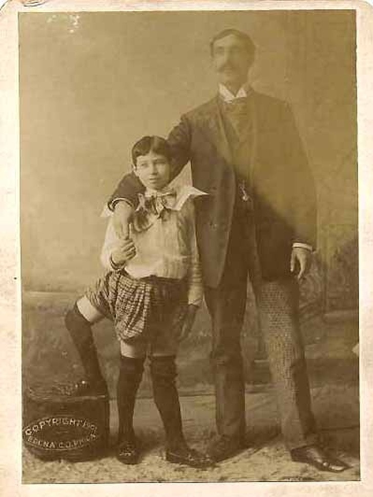 Francesco Lentini ở Italy là một nhân vật nổi tiếng lịch sử khi bị dị tật bẩm sinh nên chào đời tới 3 chiếc chân. Người ta cho rằng sở dĩ Lentini có 3 chân là vì ông có một người anh em song sinh chưa hoàn thiện và bị dính liền. Gia đình của Francesco có đến 11 anh chị em và đều hoàn toàn khỏe mạnh.