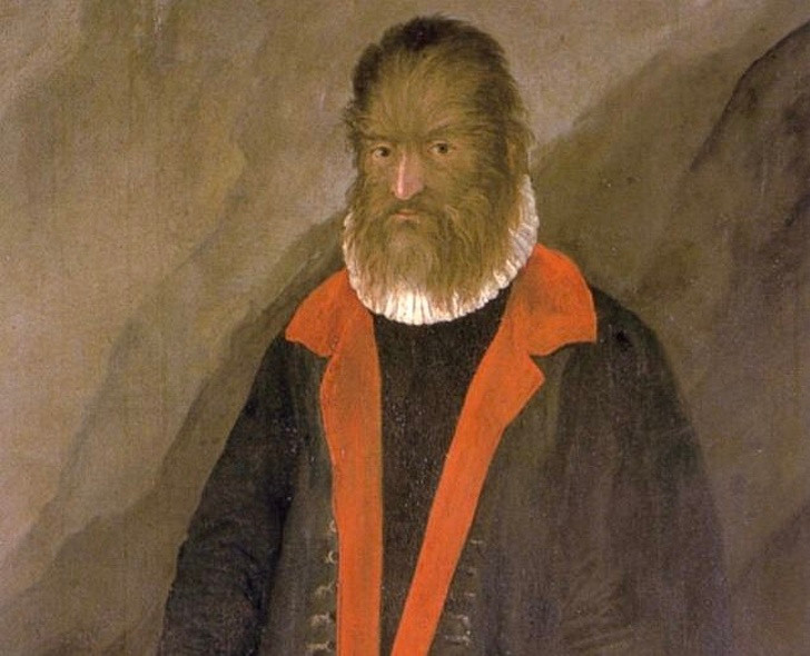 Nhiều người biết đến câu chuyện "Người đẹp và quái vật". Lịch sử từng ghi nhận một phiên bản đời thực của câu truyện cổ tích trên. Cụ thể, vào năm 1537, một đứa trẻ đã chào đời tại đảo Tenerife (Tây Ban Nha) với toàn bộ cơ thể được bao phủ bởi một lớp lông dày. Đây là người có ngoại hình dị thường như "quái vật" tưởng chừng chỉ xuất hiện trong truyện cổ tích.