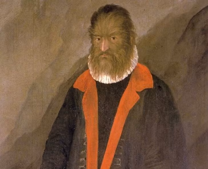 Nhiều người biết đến câu chuyện "Người đẹp và quái vật". Lịch sử từng ghi nhận một phiên bản đời thực của câu truyện cổ tích trên. Cụ thể, vào năm 1537, một đứa trẻ đã chào đời tại đảo Tenerife (Tây Ban Nha) với toàn bộ cơ thể được bao phủ bởi một lớp lông dày. Đây là người có ngoại hình dị thường như "quái vật" tưởng chừng chỉ xuất hiện trong truyện cổ tích.