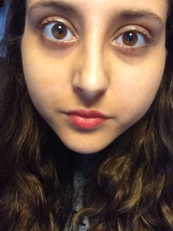 Gai xinh bi hong giac mac vi kinh ap trong