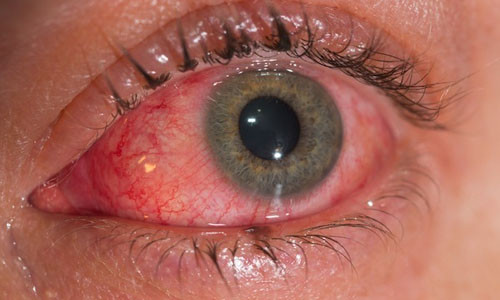 Đau mắt do virus Zika. Ảnh minh họa.