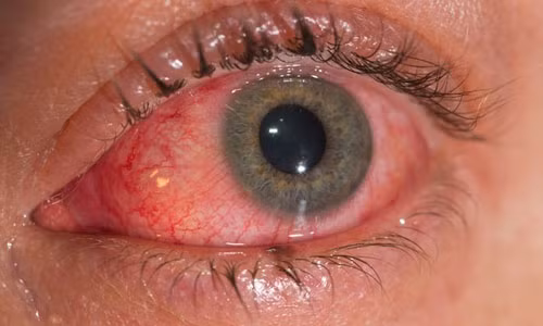 Đau mắt do virus Zika. Ảnh minh họa.