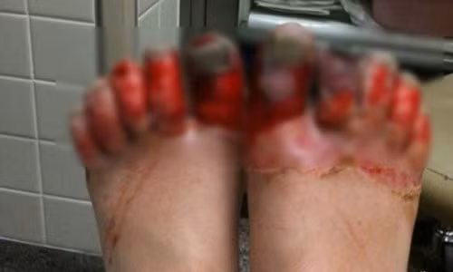 Có thể hoại tử chi, mất chân vì nhiễm lạnh. (Ảnh minh họa).