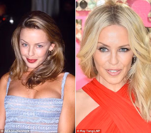 Nữ ca sĩ Kylie Minogue mặc dù đã 48 tuổi nhưng so với hình ảnh cô 10 năm trước, Kylie chẳng già đi là mấy, lý do là vì cô dùng Botox.