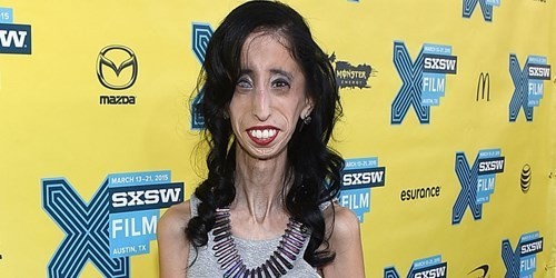  Cô gái xấu xí nhất thế giới Lizze mắc một căn bệnh hiếm gặp dẫn đến mù một bên mắt trái và cũng làm tiêu huỷ hết lượng mỡ tích trữ trong cơ thể. Điều đó có nghĩa là lượng mỡ trong cơ thể Lizze ở mốc 0% và chưa bao giờ cân nặng của cô vượt quá 29 kg.