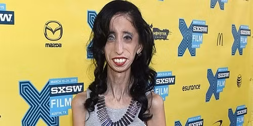  Cô gái xấu xí nhất thế giới Lizze mắc một căn bệnh hiếm gặp dẫn đến mù một bên mắt trái và cũng làm tiêu huỷ hết lượng mỡ tích trữ trong cơ thể. Điều đó có nghĩa là lượng mỡ trong cơ thể Lizze ở mốc 0% và chưa bao giờ cân nặng của cô vượt quá 29 kg.