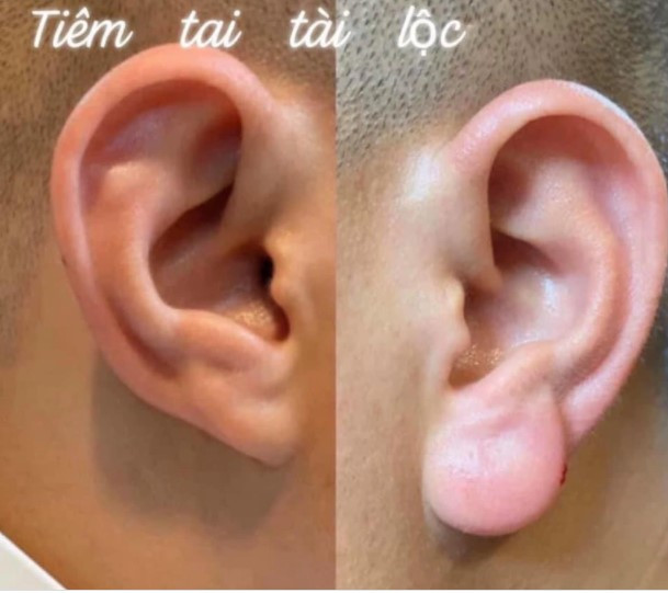 La lung trao luu dan ong dua nhau di tiem tai “Phat Di Lac“