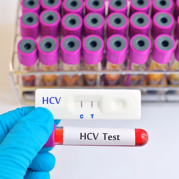 Xét nghiệm viêm gan C. Viêm gan C là một bệnh rất phổ biến, dễ lây lan với những biến chứng gây ung thư khó lường. Nên tham gia xét nghiệm này mỗi năm năm một lần.