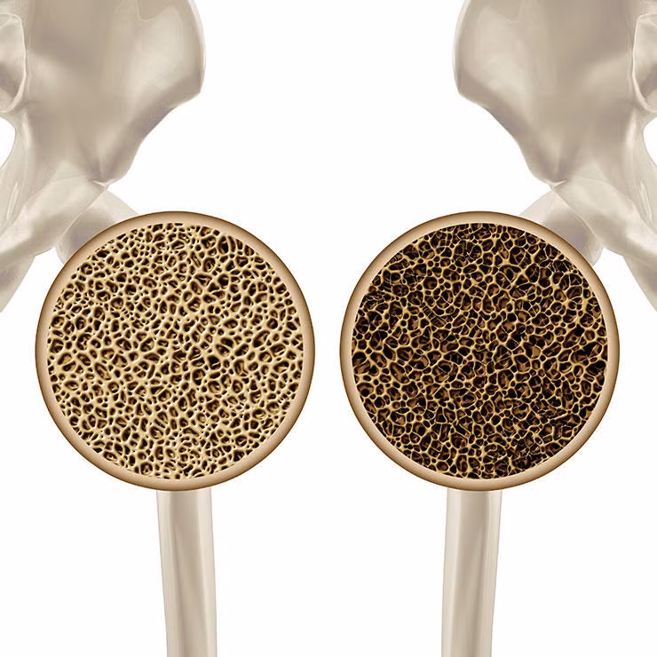 Phụ nữ ngoài tuổi 65 nên sàng lọc loãng xương mỗi mười năm, với những người gia đình có tiền sử loãng xương nên khám mỗi năm một lần. Đây là một trong những xét nghiệm quan trọng nhất với phụ nữ ở độ tuổi này.