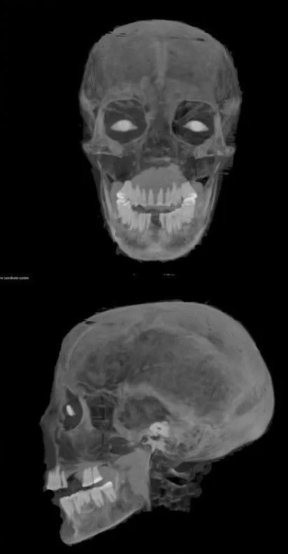 Sau khi dựng đứng xác ướp và buộc vào một cây cột bằng dây thừng mỏng, chuyên gia Brown cho rằng, những người mai táng đã hạ quan tài qua đầu Chenet-aa trước khi nối vết rạch lại bằng dây bện. Sau khi quan tài cartonnage trở nên chắc chắn, họ đổ thạch cao lên trên.