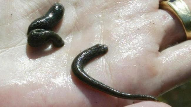 Sử dụng đỉa để chữa bệnh không phải là điều quá xa lạ, nó đã được sử dụng từ 2.500 năm trước đây. Mặc dù việc dùng đỉa đã bi loại bỏ phần lớn trong y học hiện đại, nhưng vẫn có không ít trường hợp.