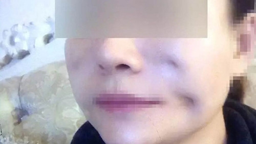 Tham làm đẹp giá rẻ người lõm mặt, người chằng chịt sẹo lồi.