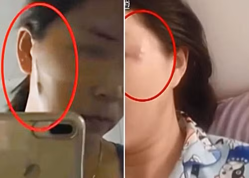 Tham làm đẹp giá rẻ người lõm mặt, người chằng chịt sẹo lồi.